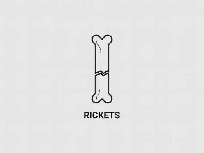 Rickets Symptoms, Causes and Treatment