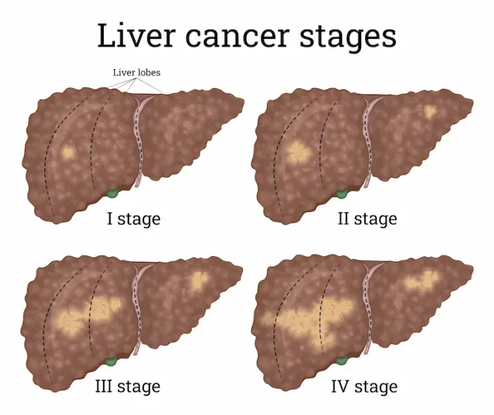 Signs of Liver Cancer Causes, Symptoms, and When to See a Doctor