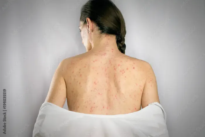 Syphilis Symptoms, Causes, and Treatment Information