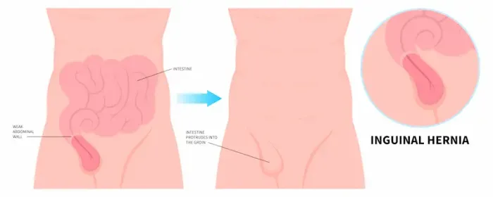 Understanding Inguinal Hernia and Its Management