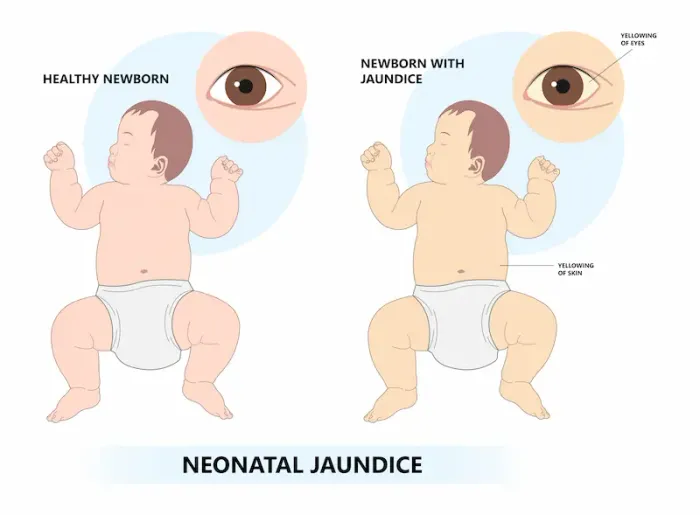 Understanding Neonatal Jaundice Causes and Treatment