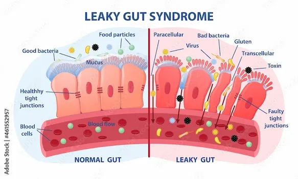 What Leads To Signs Of Leaky Gut Syndrome Diet Test Treatment