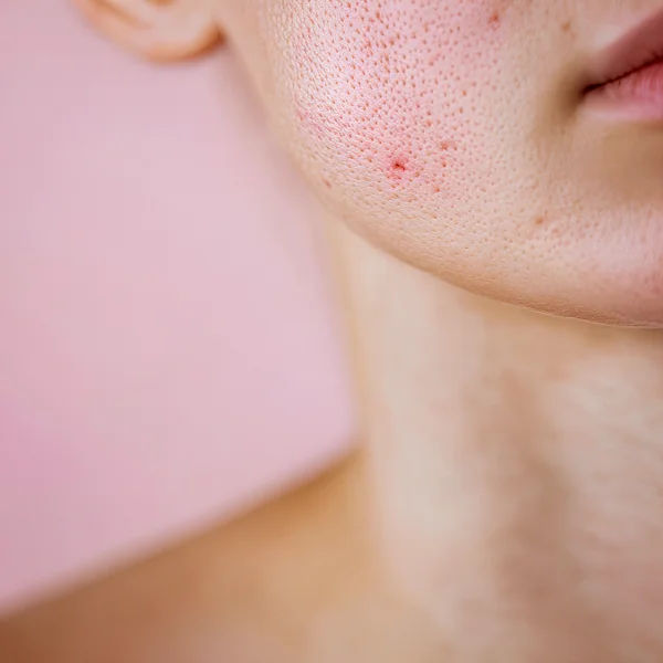 Your Guide to Clear Skin; How to Avoid Acne During Pregnancy