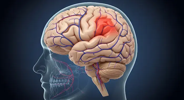 Brain Haemorrhage