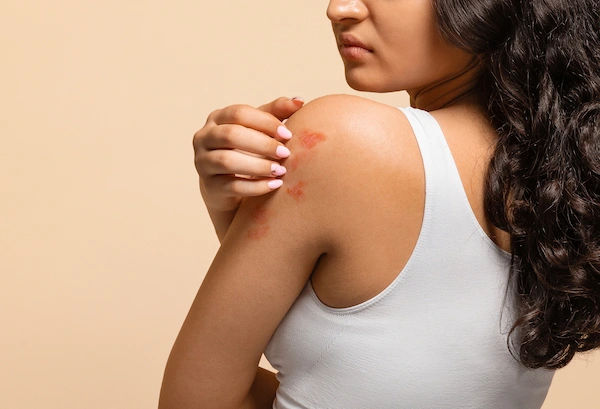 skin rashes