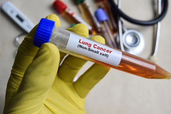 A Patient's Guide to Targeted Therapy for Non-Small Cell Lung Cancer