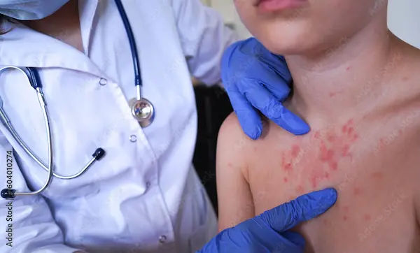 Chickenpox and Monkeypox: Key Differences