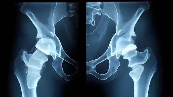 Regain Your Mobility: The Life-Changing Benefits of Hip Revision Surgery