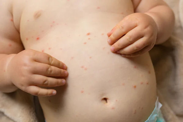 Chickenpox: Recognising the Signs and Effective Prevention Strategies