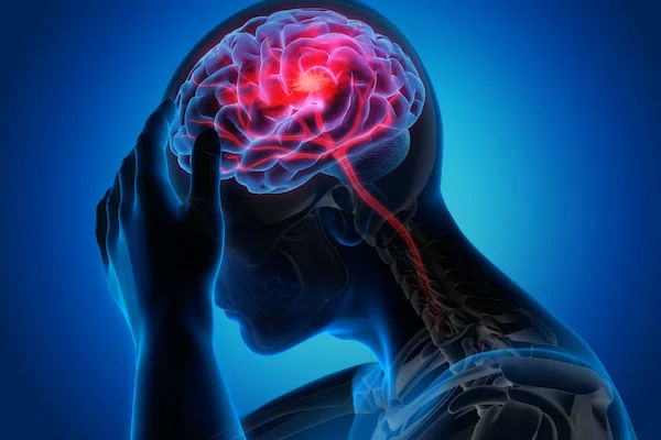 Guide to Stroke Management in Advanced Brain Stroke Centres