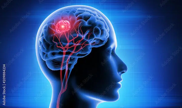 Brain Tumour