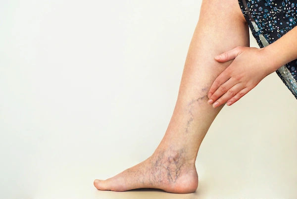 dvt