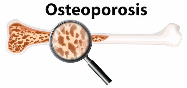 osteoporosis