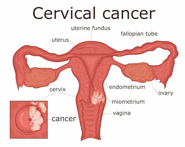 Early Signs of Cervical Cancer: What Every Woman Should Watch For