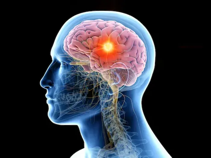 Guide to 8 Silent Signs Brain Tumor You Should Know