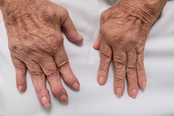 rheumatoid arthritis