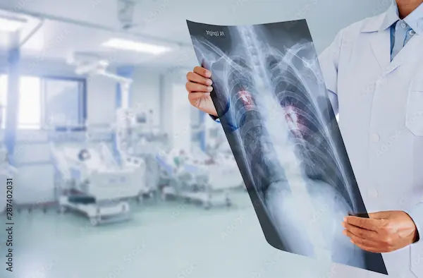 Climate Change And Tuberculosis