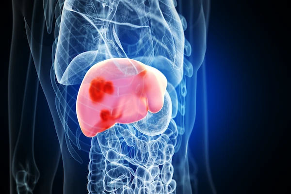liver cancer