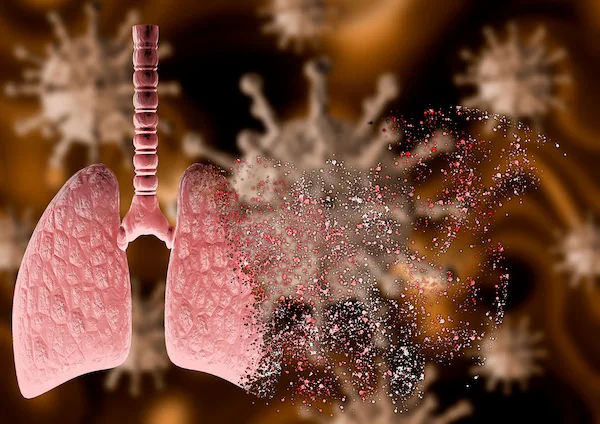 Guide to Understanding Pneumonia