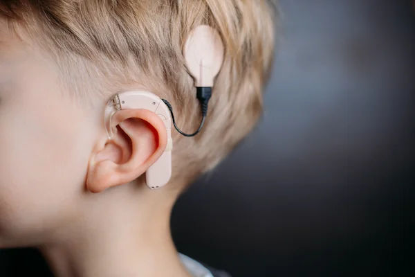 Cochlear Implants: Life-Changing Benefits