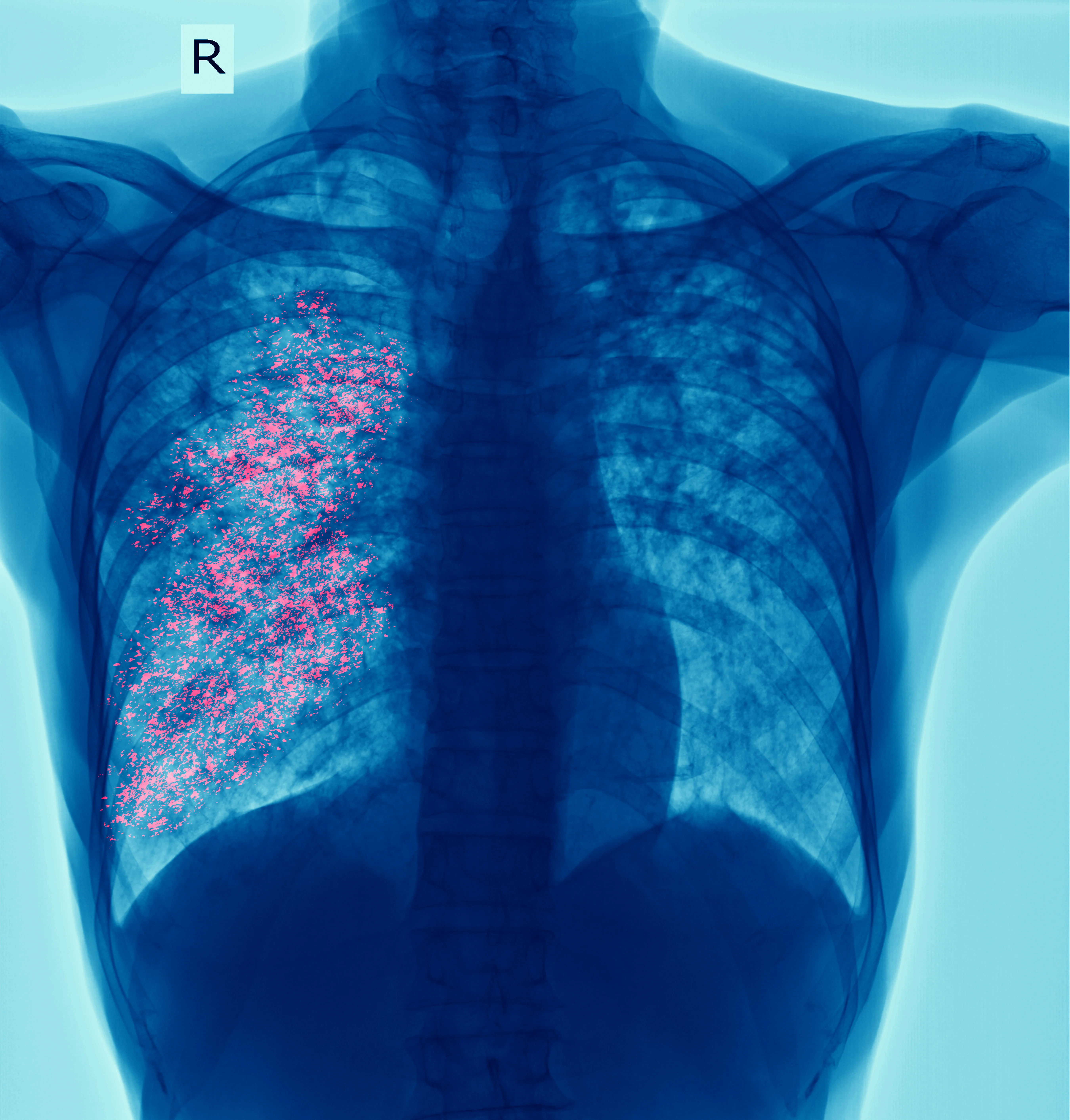 The Future of TB Management: Shorter Treatments, Smarter Tech, and Hope