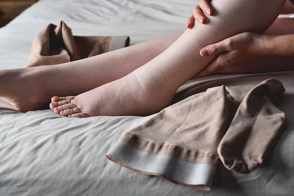 Living Well with Lymphedema: Your Practical Guide to Management and Relief