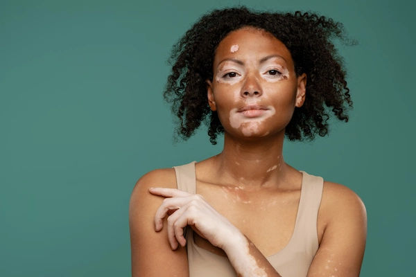 vitiligo