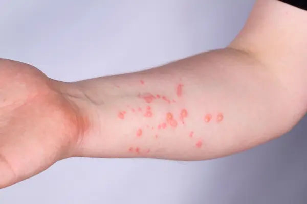 Monkeypox: Treatment and Management Options