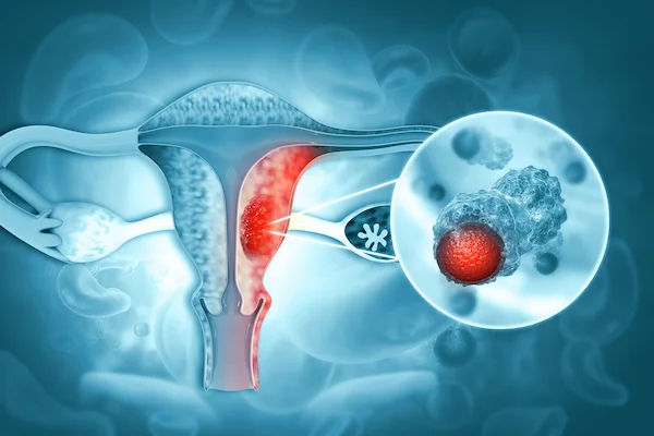 Signs of Ovarian Cancer: Recognising the Subtle Warnings