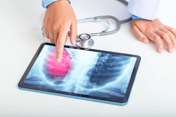 Your Winter Guide to Pneumonia: Symptoms, Prevention, and Care