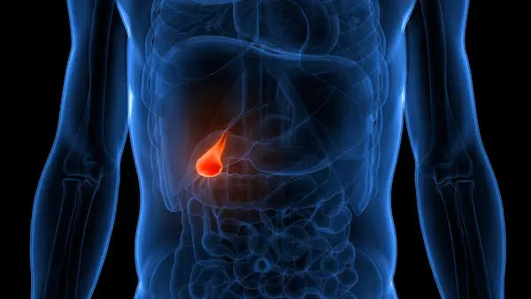 Gall Bladder Stones