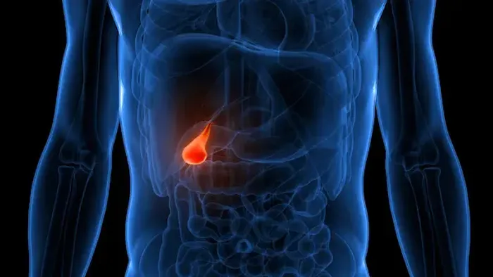 Gall Bladder Stones