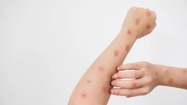 Can You Catch Monkeypox After Chickenpox?