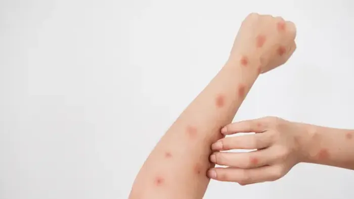 Can You Catch Monkeypox After Chickenpox?