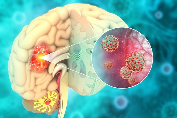 brain tumours