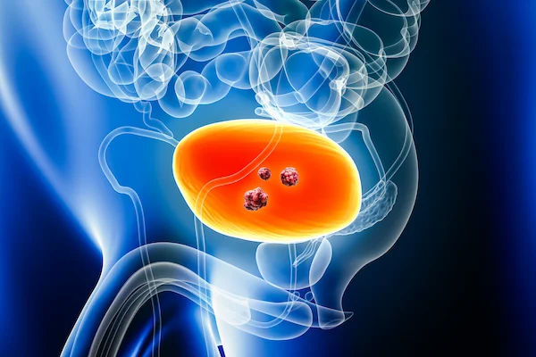 What Leads To Signs Of Bladder Cancer: Understanding Types and Symptoms