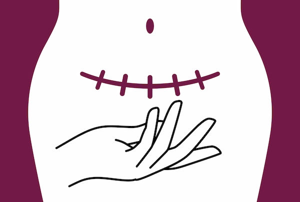 cesarean