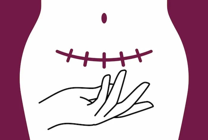 cesarean