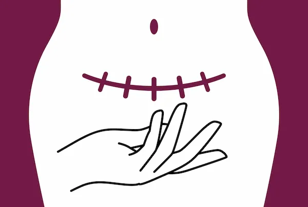 cesarean