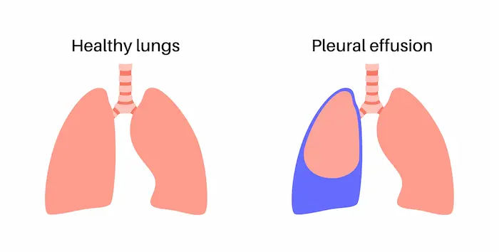 What Leads To Signs Of Pleural Effusion And Types