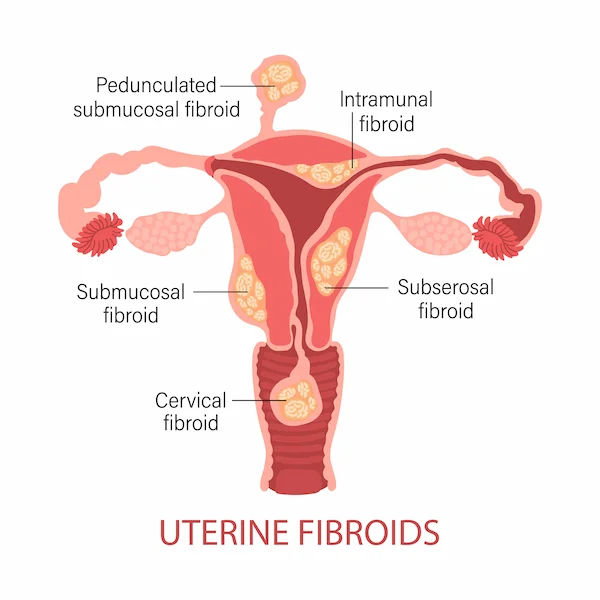 Abnormal Uterine Bleeding: Your Guide to Causes, Symptoms, and Care