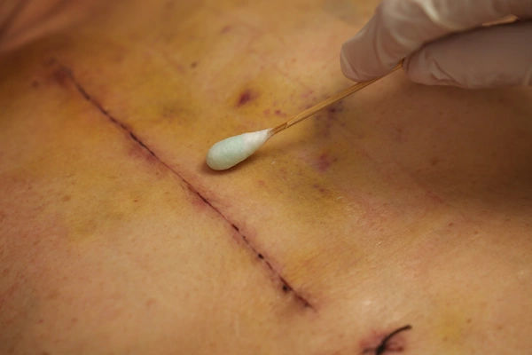 healing of sternum