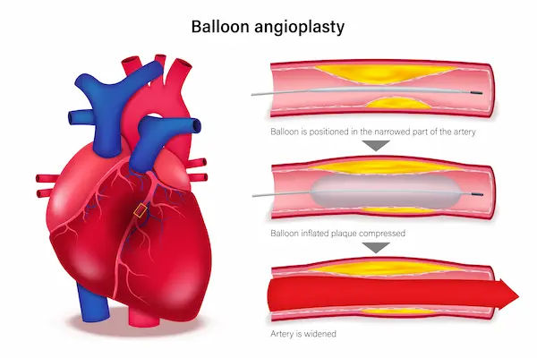 Guide to Doctors Use Balloon Cryoablation Procedure To Treat Arrhythmia
