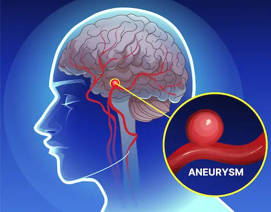 Aneurysm