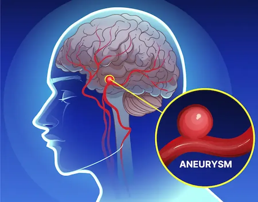 Guide to Aneurysm Risk Factors What Know