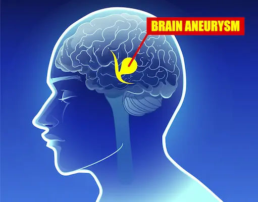 Brain Aneurysms