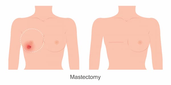 Risk Factors Of Mastectomy