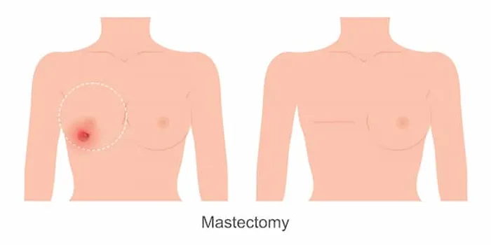 Risk Factors Of Mastectomy