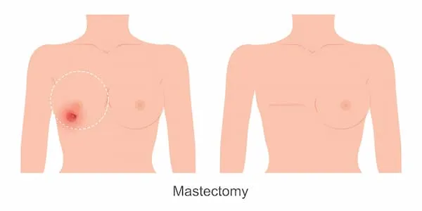 Risk Factors Of Mastectomy