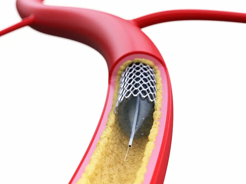 Angioplasty